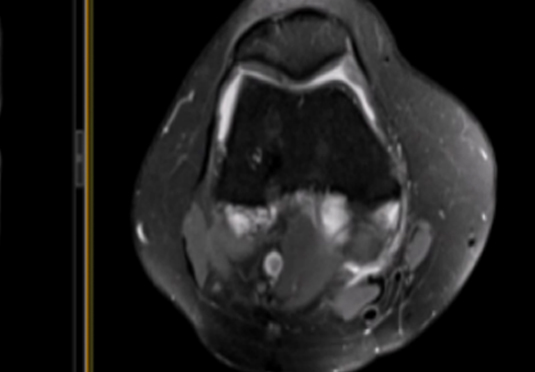 微創(chuàng)射頻消融術(shù)